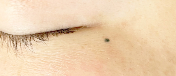 ほくろアートメイクの画像