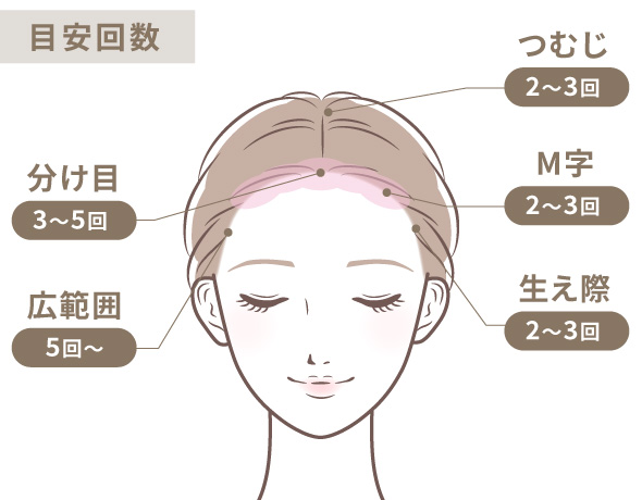 頭皮アートメイクの画像