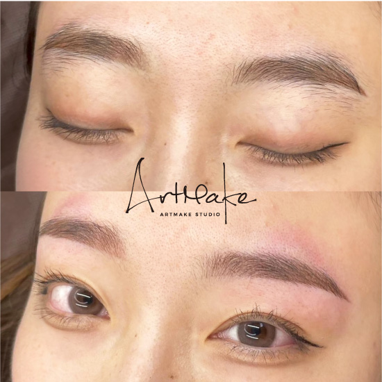 医療針脱毛症例