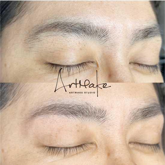 医療針脱毛症例