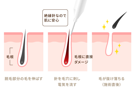 医療針脱毛とは
